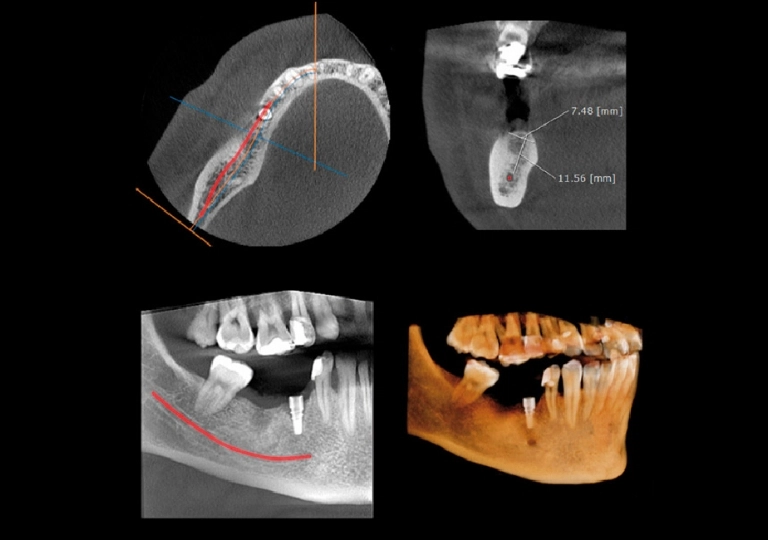 zdjęcia rtg jamy ustnej